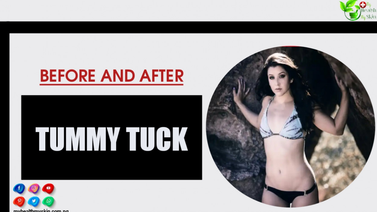 Tummy Tuck Before And After See Photos Of Celebrities And Discover How To Have A Great Result