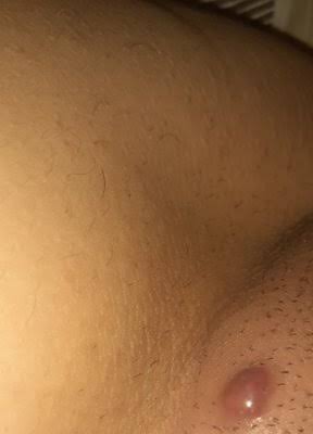 Pimple Like Bump On Clitorial Hood