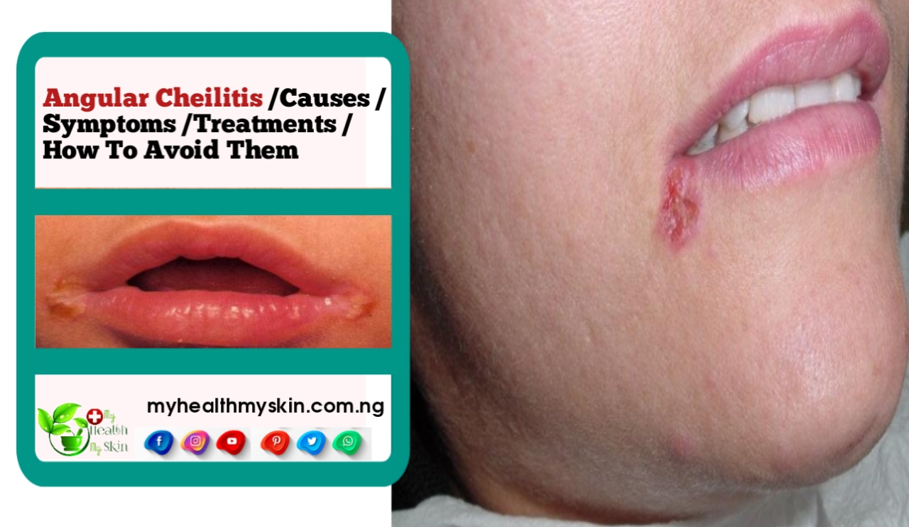 Angular Cheilitis (Perlèche) – Causes, Symptoms, Treatments And How To Avoid Them