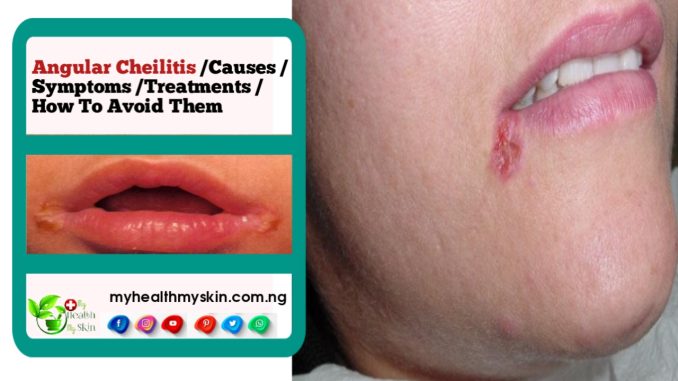 Angular Cheilitis (Perlèche) – Causes, Symptoms, Treatments And How To Avoid Them