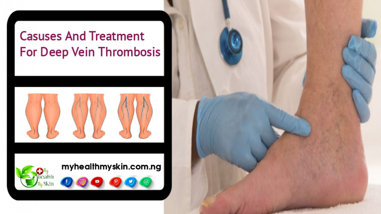 Casuses And Treatment For Deep Vein Thrombosis