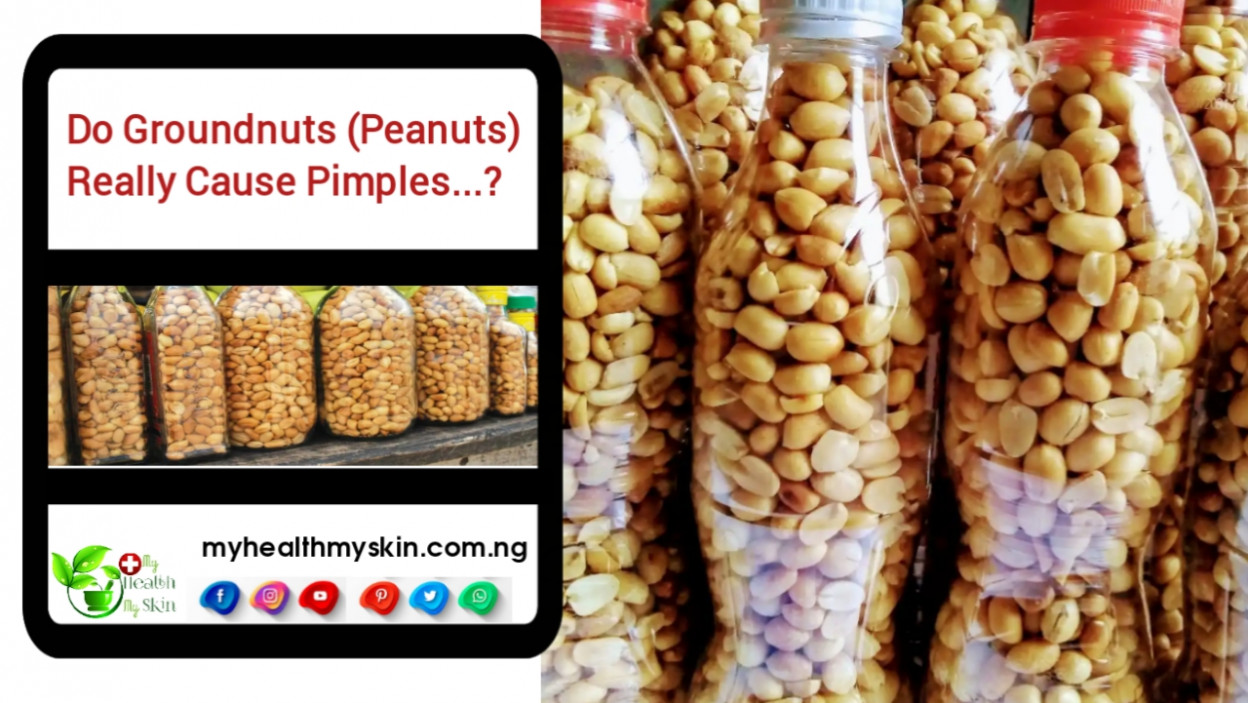 Do Groundnuts Peanut Really Cause Pimples Check All Details Here