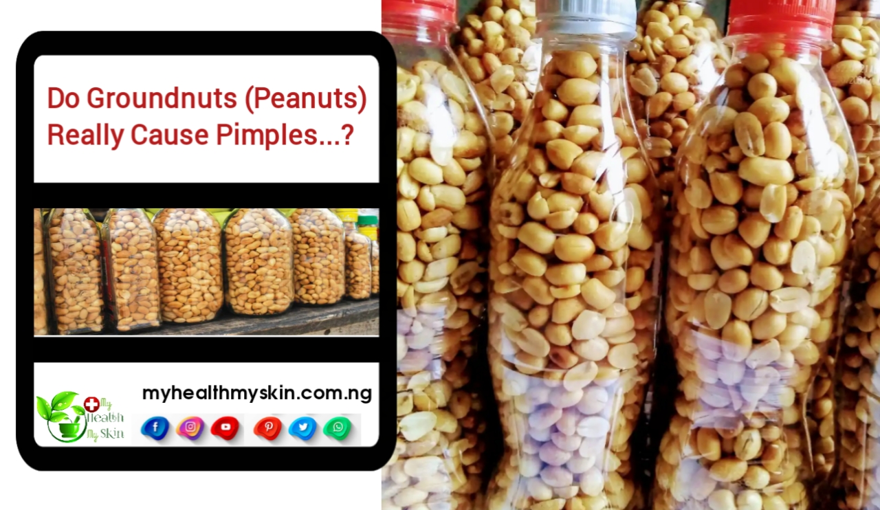 Do Groundnuts (Peanuts) Really Cause Pimples? Check All Details Here!