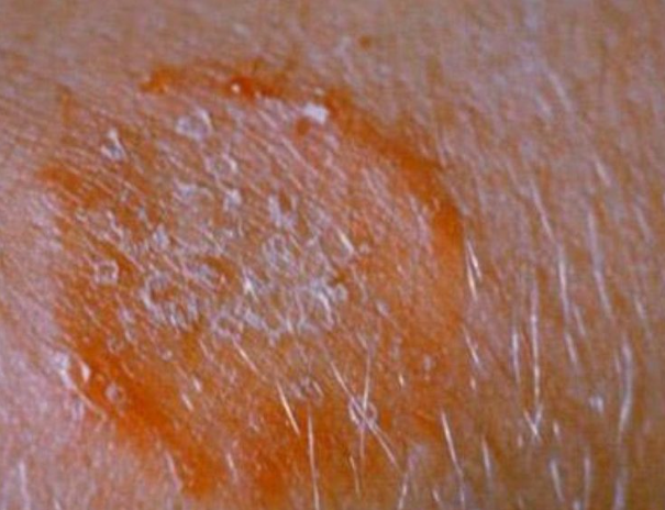 Tinea Infections (Ringworm) – What It Is, Causes, Symptoms And Treatments
