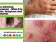 Tinea Infections (Ringworm) – What It Is, Causes, Symptoms And Treatments