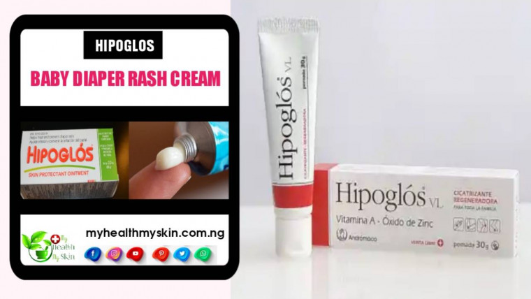 Hipoglos Baby Diaper Rash Cream: Know Everything About This Cream