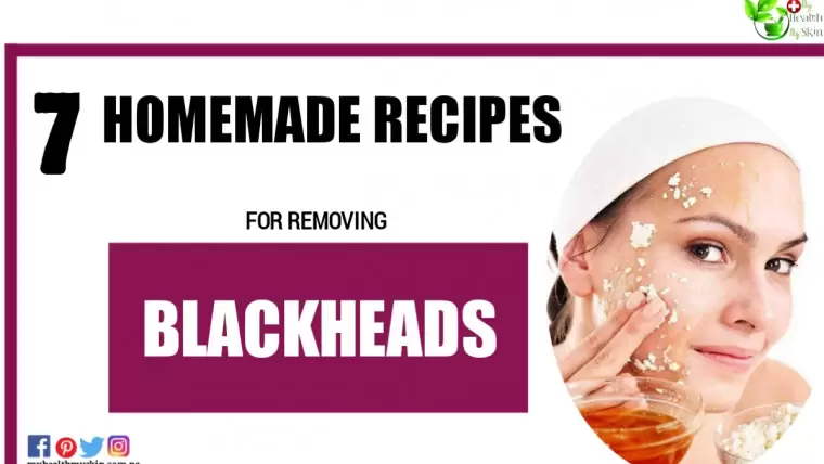 7 Homemade Recipes For Removing Blackheads