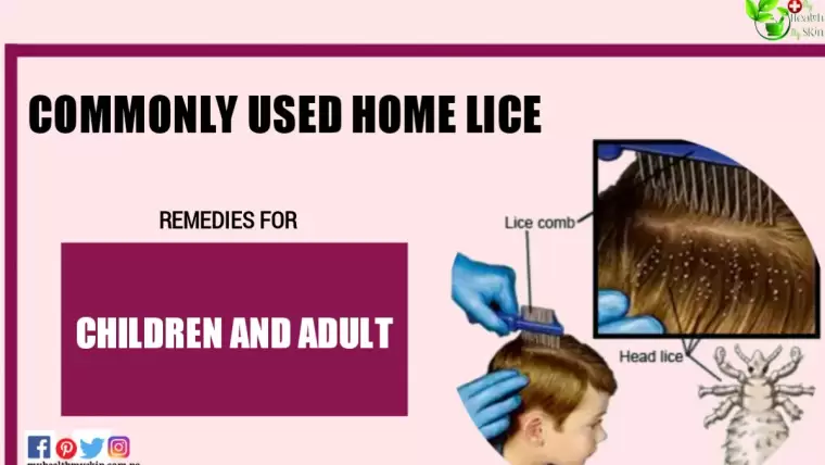 Commonly Used Home Lice Remedies for Children and Adult