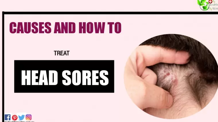 Head Sores - Causes And How To Treat