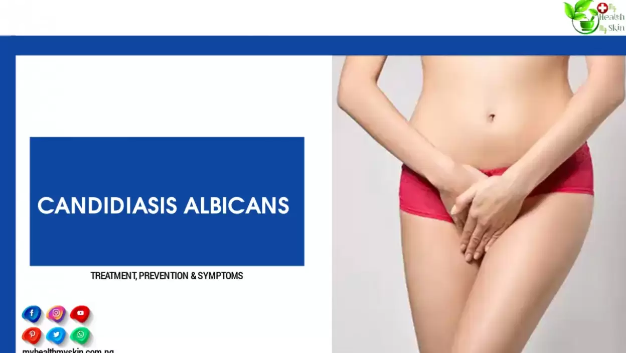 Candidiasis Albicans: Treatment, Prevention & Symptoms – 13 Most Used Remedies