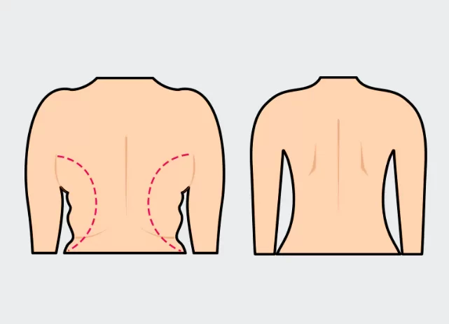the before and after lipo