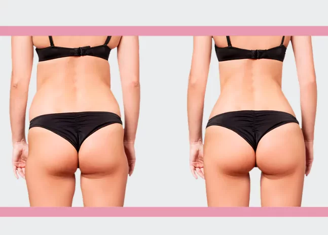 Result of liposuction on the flanks