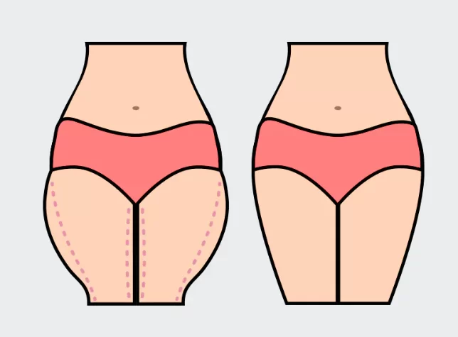 The before and after of thighs lipo