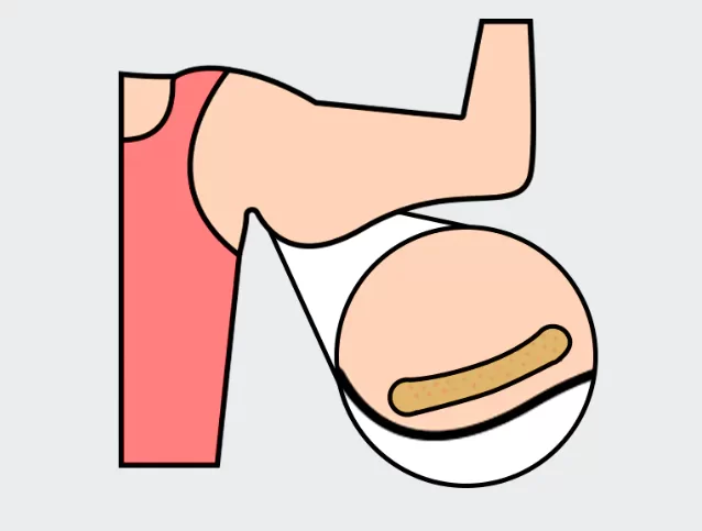 The before and after of arm liposuction