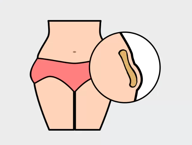 before and after liposuction in the culote