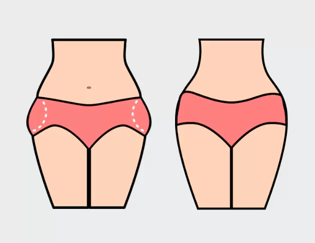 Result of liposuction on the breeches