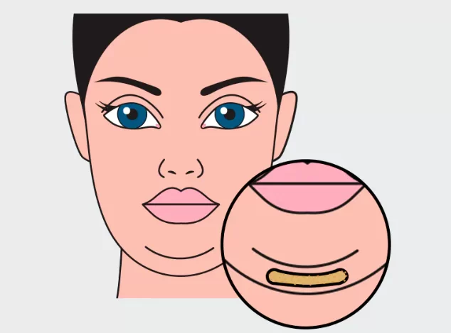 before and after submental lipo