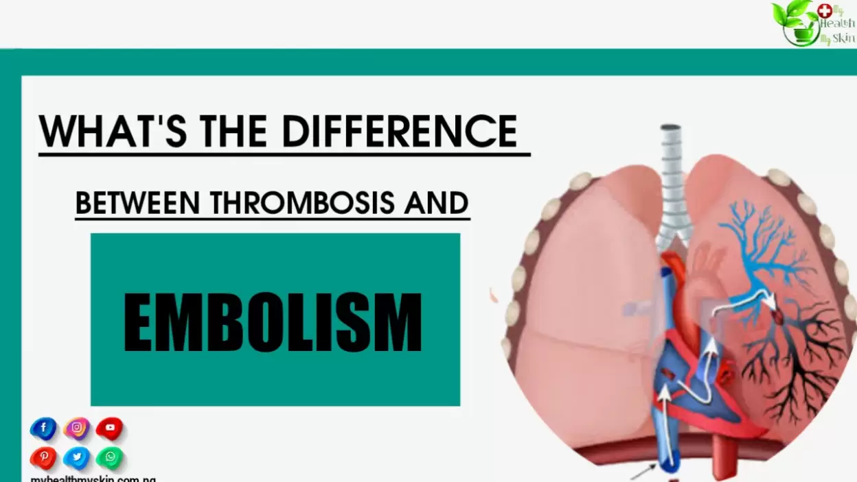 Thrombosis Vs Embolism: What's The Differences Between Difference Them?