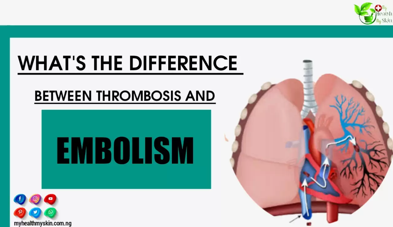 Thrombosis Vs Embolism: What's The Main Between Difference Them?