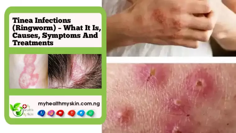 Tinea Infections Ringworm – What It Is Causes Symptoms And Treatments