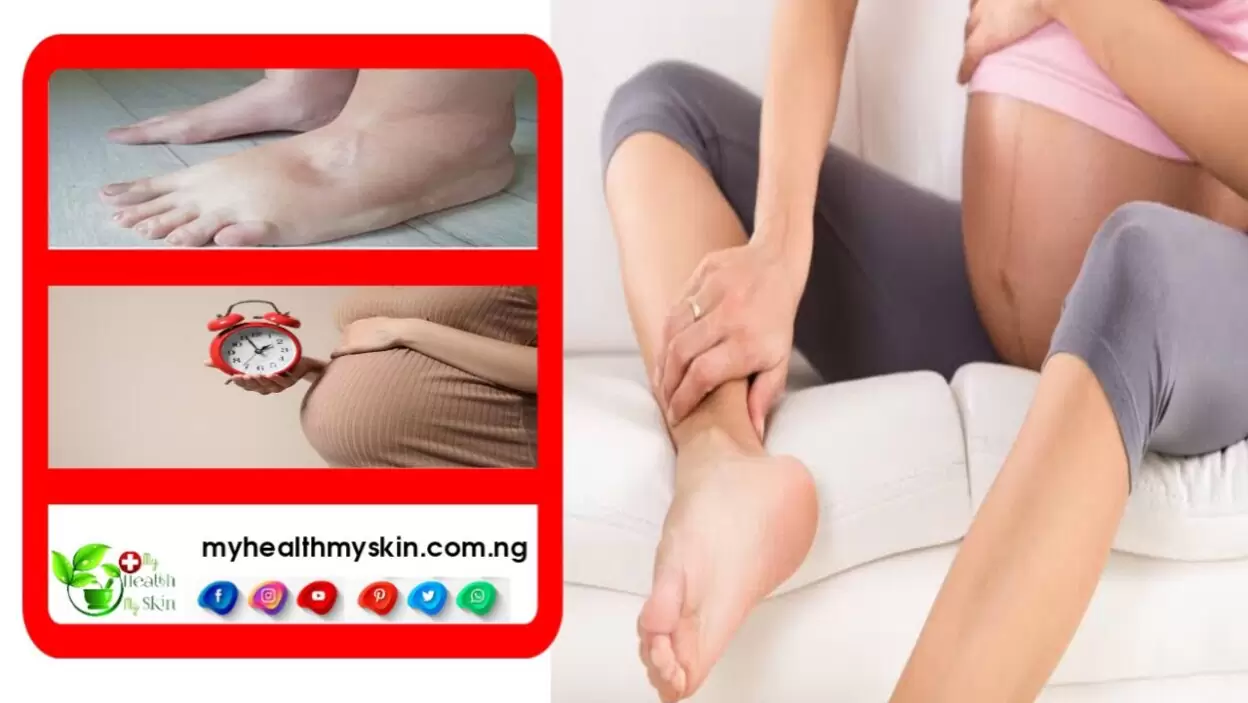 Swollen Feet And Legs During Pregnancy Is It Normal