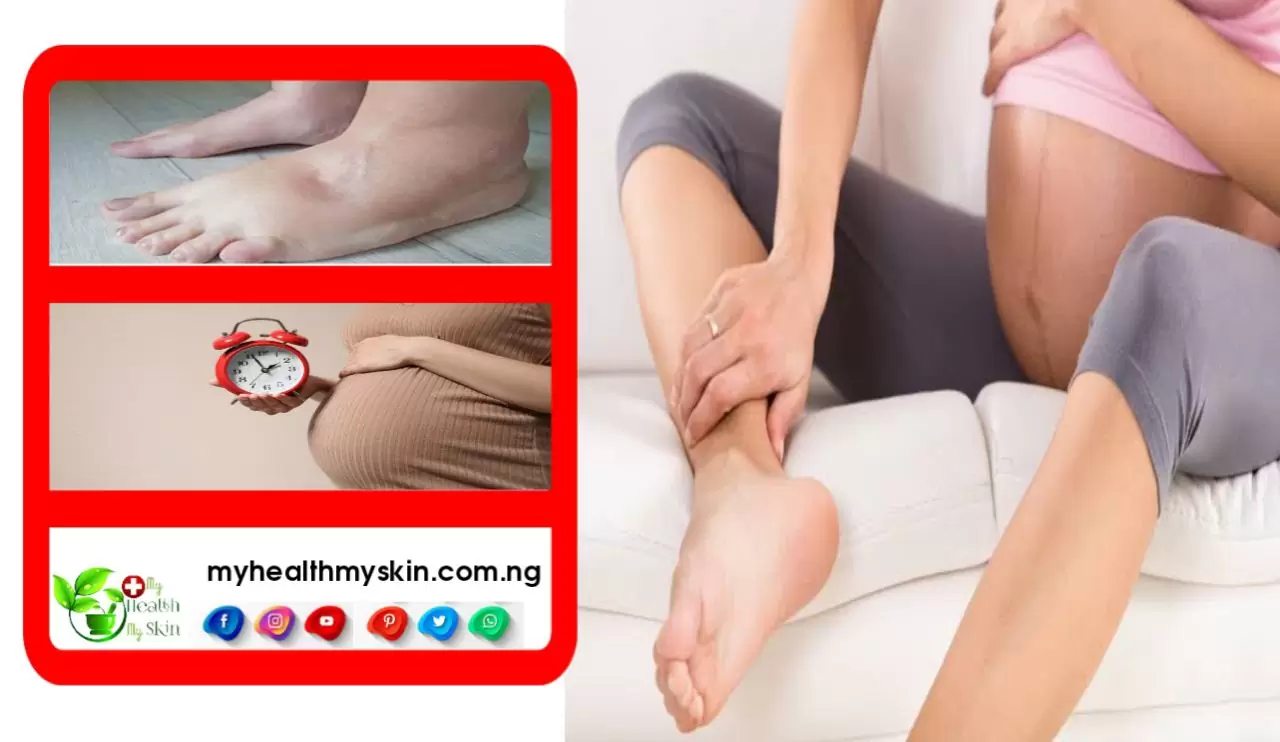 Swollen Feet And Legs During Pregnancy